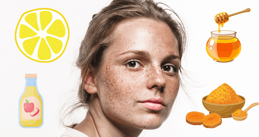 How to Remove Freckles Naturally [10 Natural and Easy Ways] 2023