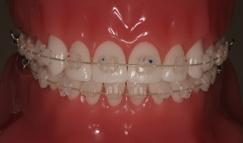 How to Brush your Teeth with Braces - Dentistry Blogger How to brush teeth with braces
