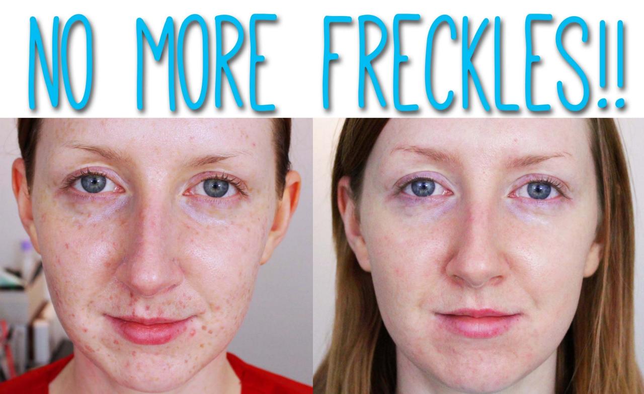 How to Remove Freckles At Home Naturally? - BeautyFoo Mall