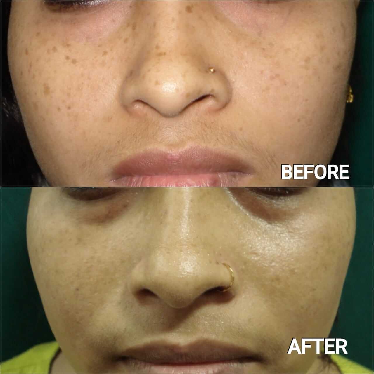 Freckles Removal