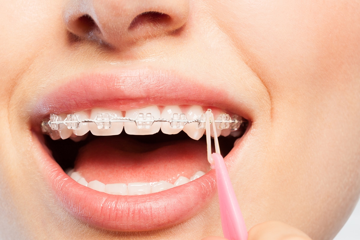 How to Properly Brush Your Teeth With Braces How to brush teeth with braces