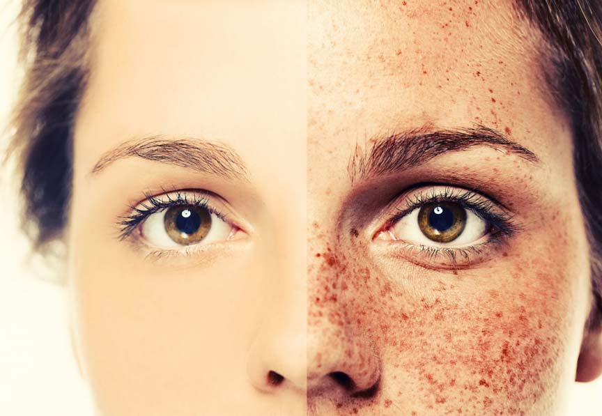 How to Get Rid of Freckles? | Getting rid of freckles, Freckles ...